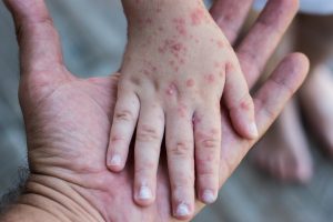 Коксаки атакует: что мы знаем о вирусе